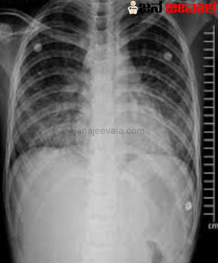 ವೈಟ್ ಲಂಗ್ ಸಿಂಡ್ರೋಮ್ -ಜಾಗತಿಕವಾಗಿ ಹರಡುತ್ತಿದೆ ನಿಗೂಢ ಶ್ವಾಸಕೋಶದ ರೋಗ ವೈಟ್ ಲಂಗ್ ಸಿಂಡ್ರೋಮ್ -ಜಾಗತಿಕವಾಗಿ ಹರಡುತ್ತಿದೆ ನಿಗೂಢ ಶ್ವಾಸಕೋಶದ ರೋಗ